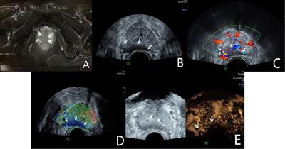 Application of Multiple Ultrasonic Techniques in the Diagnosis of Prostate Cancer